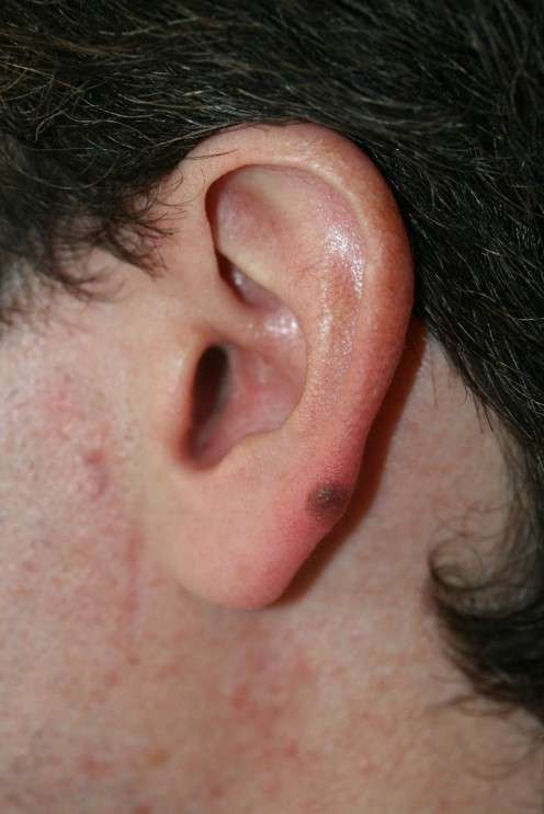 Melanoom oor.jpg